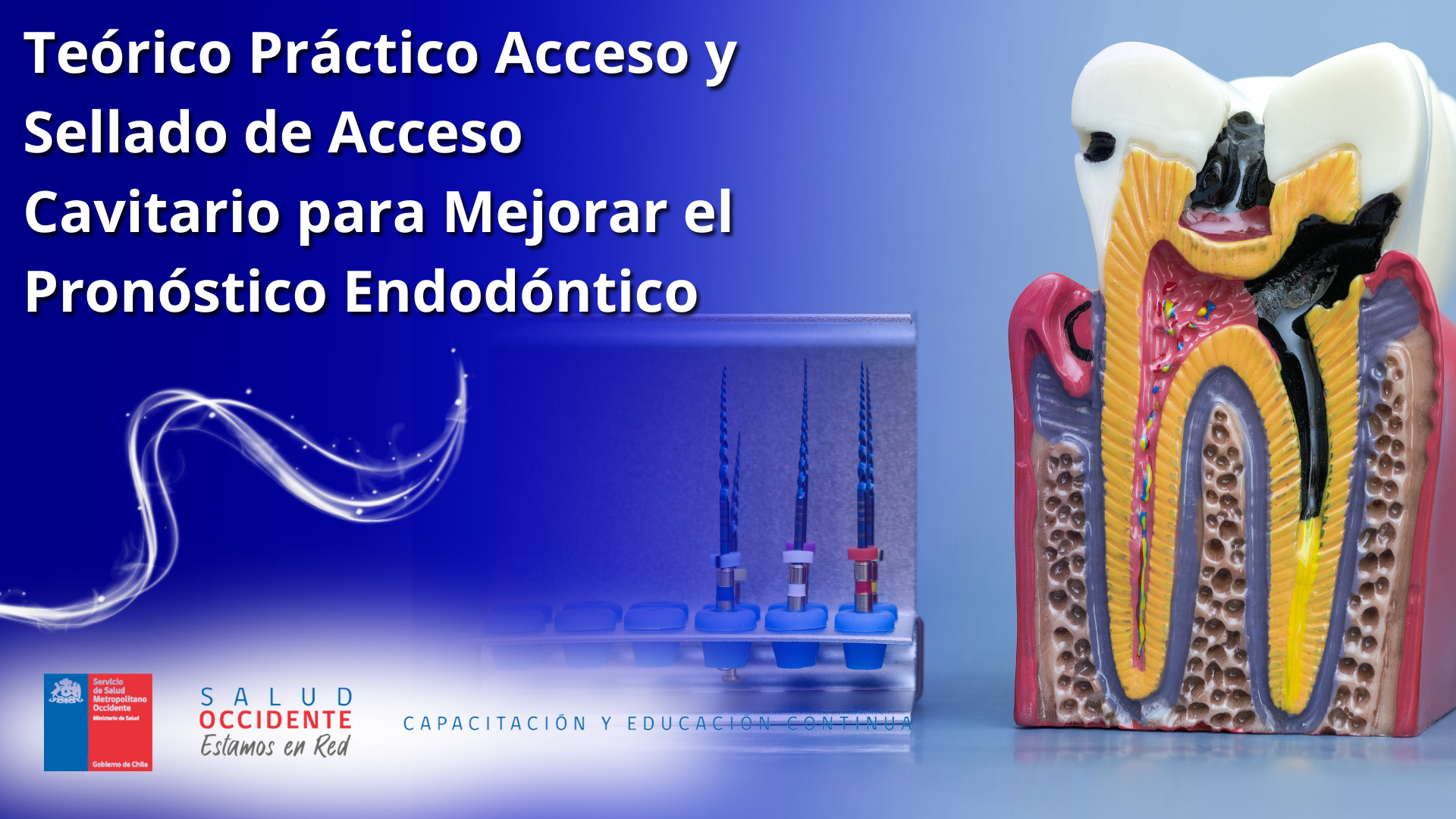 Acceso y Sellado de Acceso Cavitario para Mejorar el Pronóstico Endodóntico